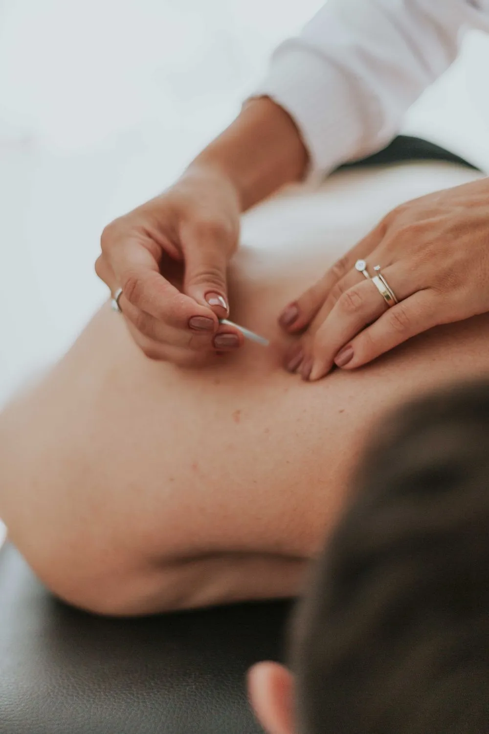 Close-up of acupuncture needles placed along a patient's back during a treatment session